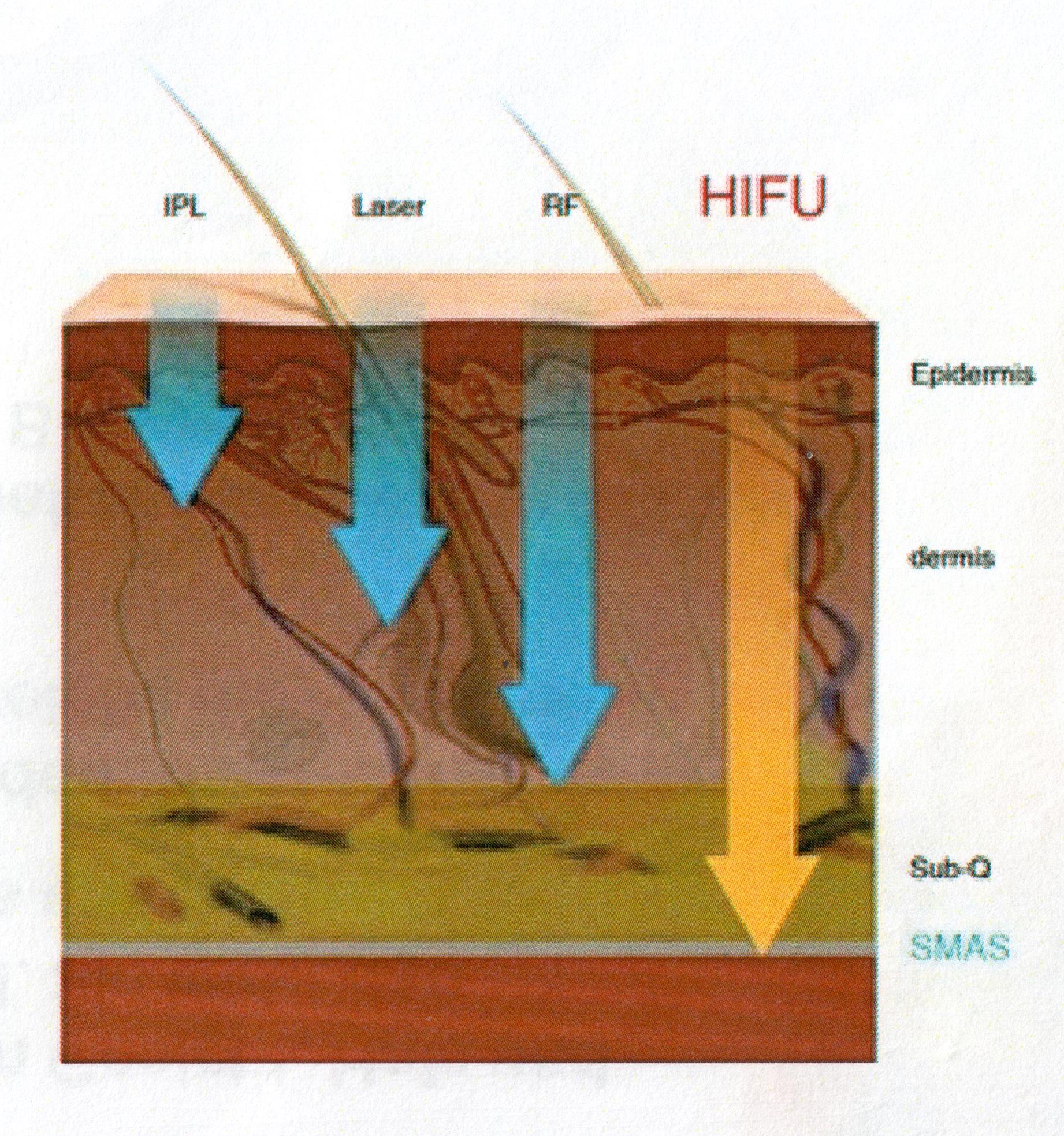 HIFU Infografik